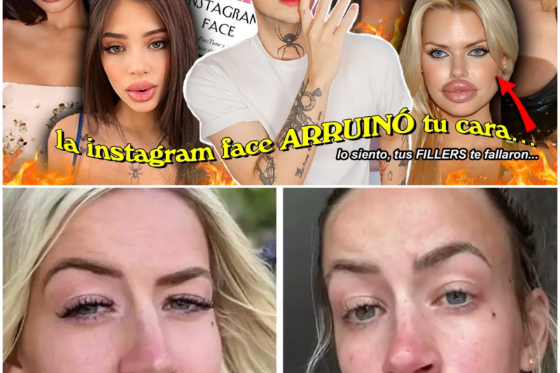 El Ocaso de la “Instagram Face”: Por Qué la Era de los Rellenos Faciales Está Llegando a su Fin y Cómo Arruinó Nuestra Identidad