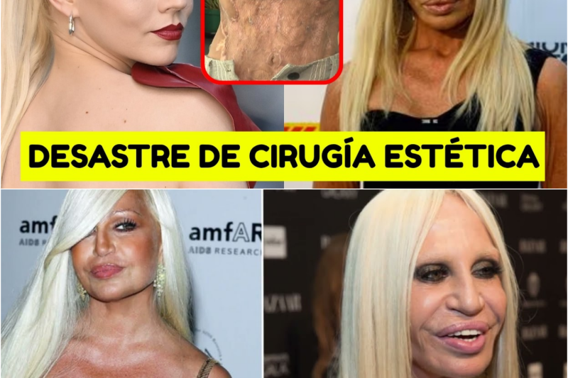 El Precio de la Perfección: Cuando la Cirugía Plástica Transforma el Sueño de Belleza en una Pesadilla Irreversible