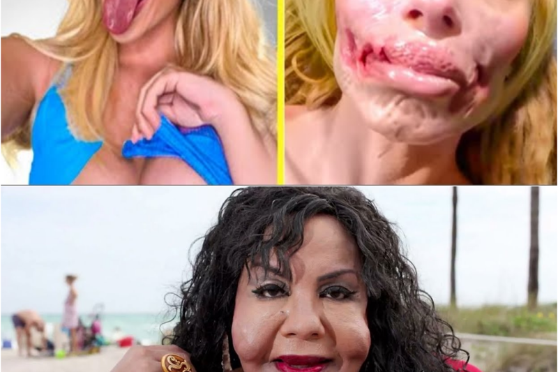 El Lado Oscuro del Bisturí: 15 Famosos Atrapados en la Pesadilla Irreversible de las Cirugías Plásticas Extremas